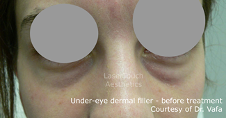 under eye dermal filler before Larchmont